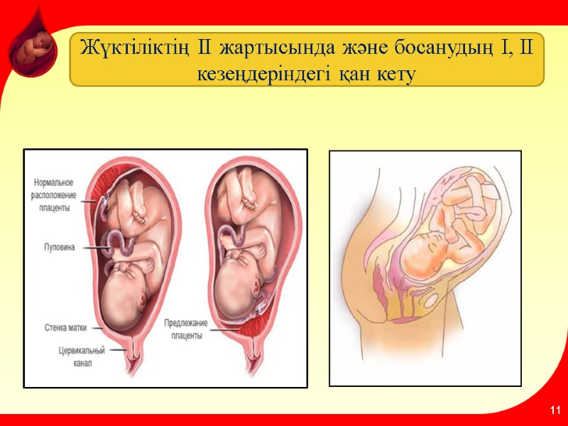 11 Жүктіліктің II жартысында және босанудың I, II кезеңдеріндегі қан кету